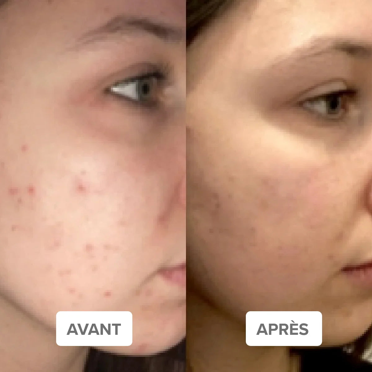 ROTINA PARA PELE ZERO ERROS – Cuidado completo para pele com tendência à acne | Mademoiselle Agathe